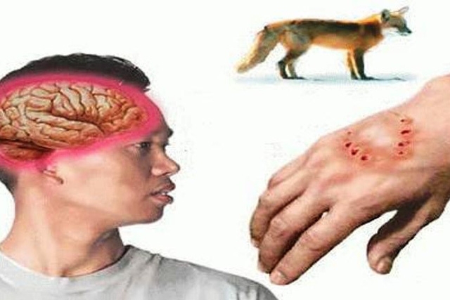 mỗ nha Bệnh dại thường ảnh hưởng lớn đến hệ thần kinh của con người, nên sau khi sơ cứu cần đưa nạn nhân đến trung tâm y tế gần nhất để được tư vấn và tiêm vaccine phòng bệnh. Ảnh minh họa