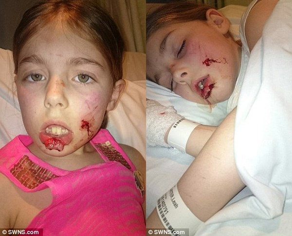 Cô bé Leah Carter với vết thương do chó cắn  /// Ảnh: Daily Mail