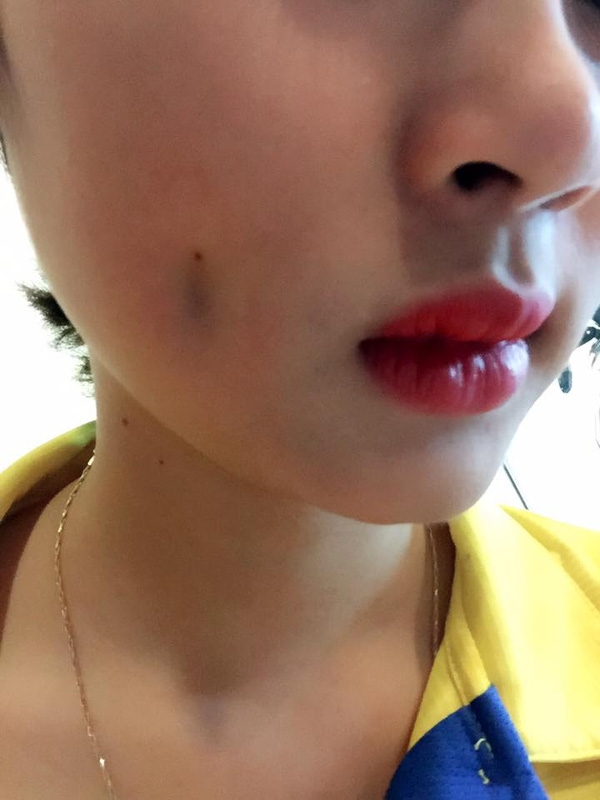 cô gái trẻ thẩm mỹ má lúm bị hỏng