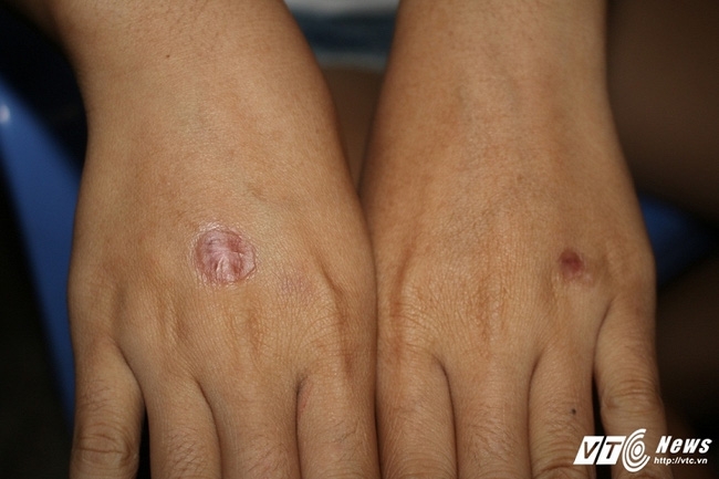 Nữ sinh run sợ kể phút bị bạn châm thuốc lá vào tay, bắt liếm chân - Ảnh 3.