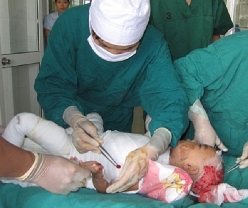 Mẹ sơ sẩy, con 14 tháng tuổi ngã vào nồi canh vừa sôi gây bỏng nặng - 1