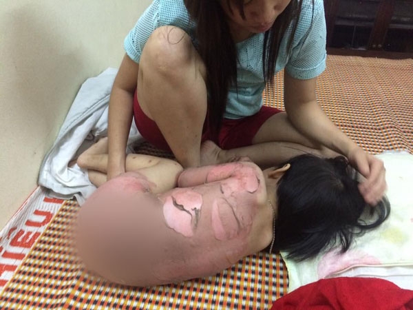 Bỏng khi tắm