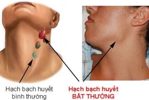 dau-hieu-nhan-biet-som-ung-thu-mau-1