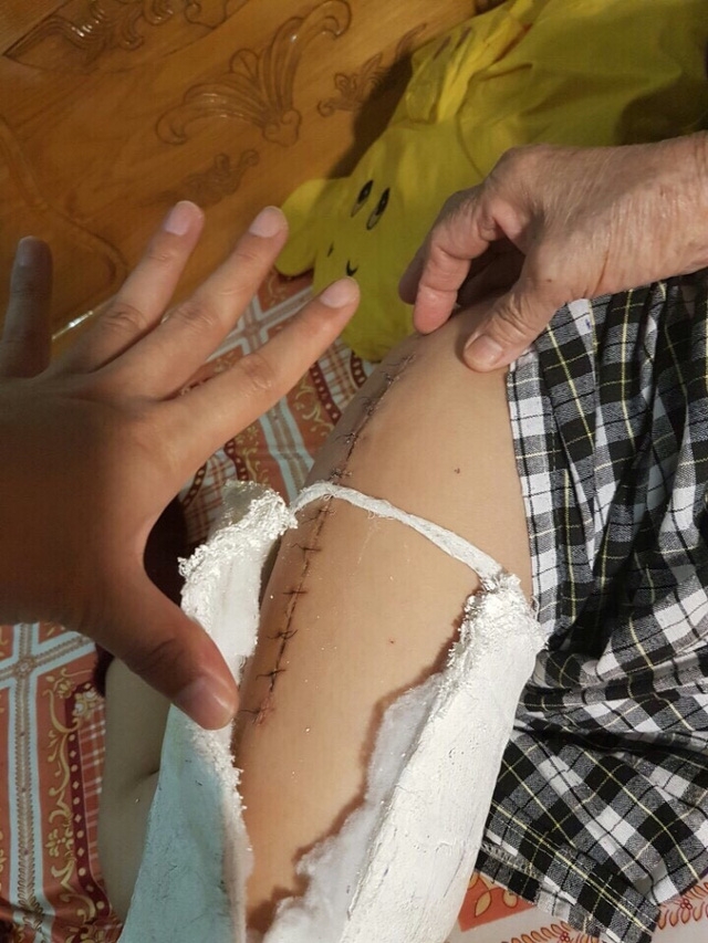 Vết thương dài sau khi mổ chân của học sinh Kiên. Ảnh GĐCC