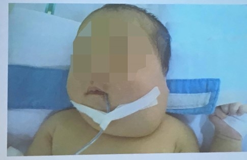 Việt Nam cắt thành công bướu quái cực hiếm, là ca thứ 2 trên thế giới - ảnh 2