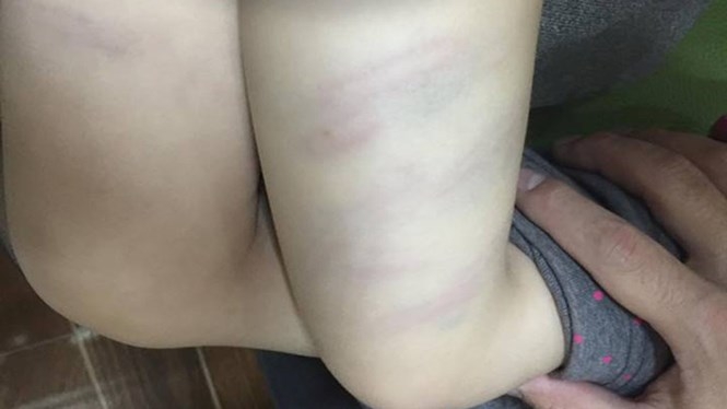 Hai chân cháu Phương bị cô giáo Linh dùng đũa đánh thâm tím /// Ảnh Minh Hải