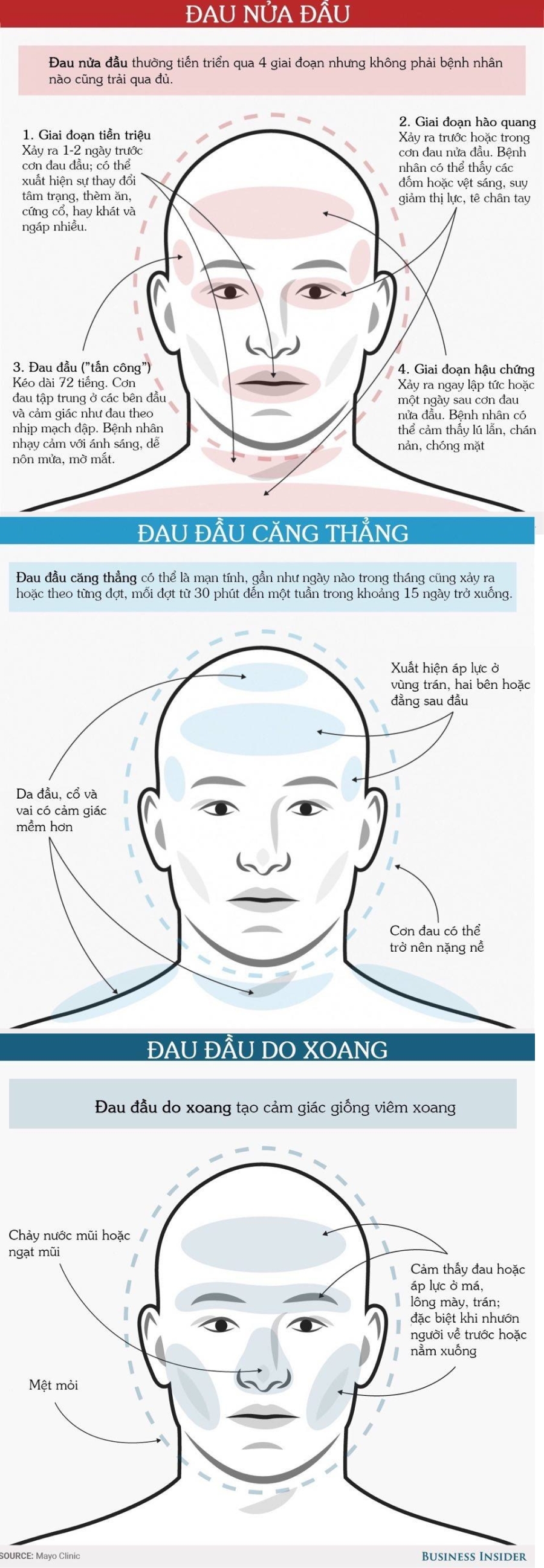 Nhận diện bệnh từ các kiểu đau đầu