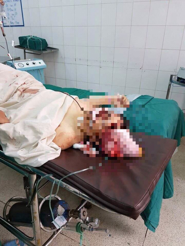  Chị Thảo bị chồng chém vỡ sọ 