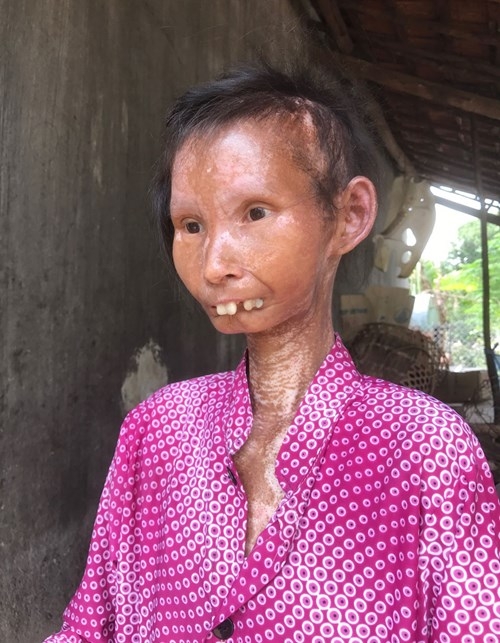 Nàng sơn nữ biến thành bà già vì bệnh lạ