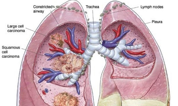 ung thư phổi, ung thư, xét nghiệm máu, phát hiện sớm ung thư, hút thuốc lá