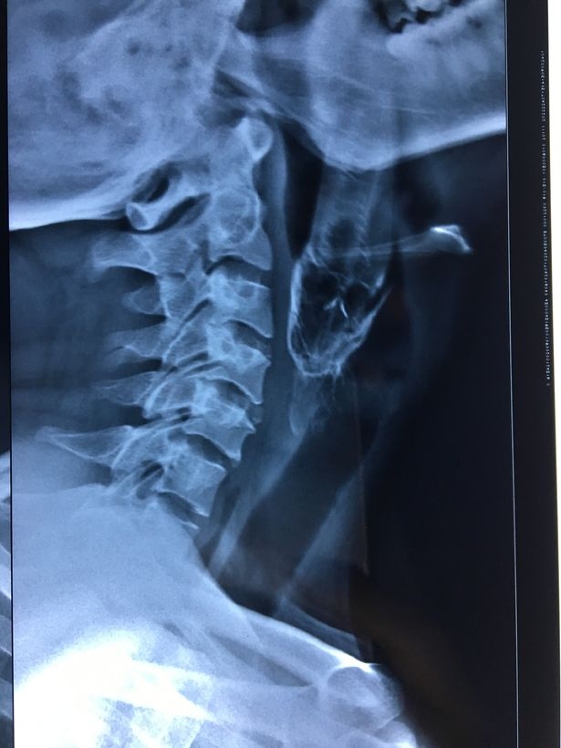 kinh di: ca dai 11cm mac ket trong hong nguoi di cau hinh anh 1