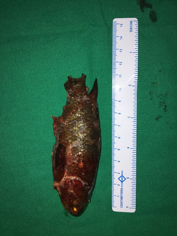 kinh di: ca dai 11cm mac ket trong hong nguoi di cau hinh anh 2