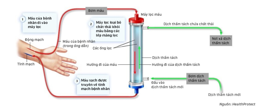 Quá trình chạy thận diễn ra như thế nào?