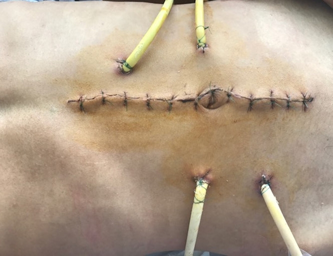 Bệnh nhân được mổ xử lý vỡ tá tràng /// Bác sĩ cung cấp