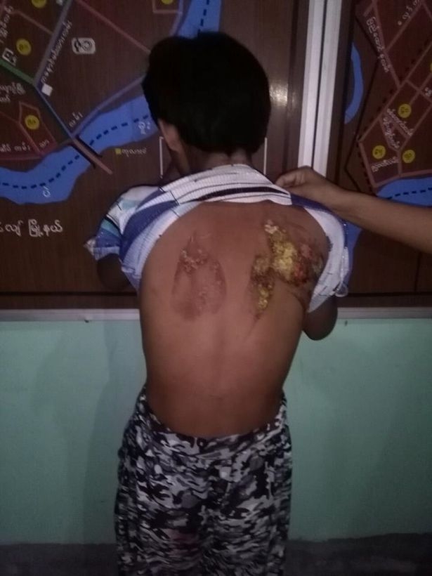 Cô bé 13 tuổi đi làm giúp việc bị chủ nhà dùng bàn là nóng bạo hành rồi đổ nước sôi lên người - Ảnh 1. Cô bé 13 tuổi đi làm giúp việc bị chủ nhà dùng bàn là nóng bạo hành rồi đổ nước sôi lên người - Ảnh 1.
