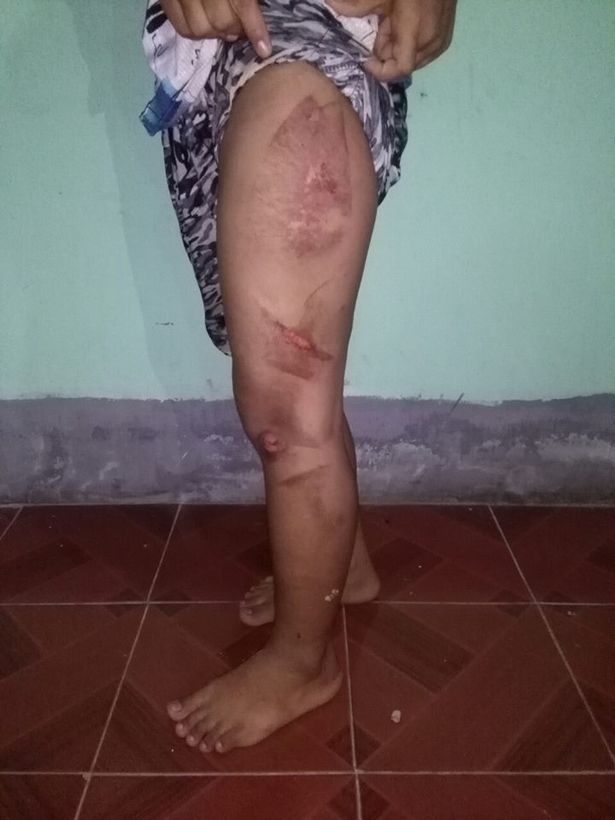 Cô bé 13 tuổi đi làm giúp việc bị chủ nhà dùng bàn là nóng bạo hành rồi đổ nước sôi lên người - Ảnh 2. Cô bé 13 tuổi đi làm giúp việc bị chủ nhà dùng bàn là nóng bạo hành rồi đổ nước sôi lên người - Ảnh 2.