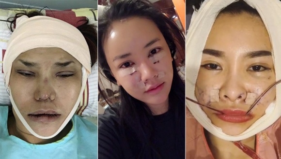 sao việt, mỹ nhân việt, sao phẫu thuật thẩm mỹ, ảnh dao kéo của sao, mỹ nhân việt phẫu thuật thẩm mỹ, phi thanh vân 
