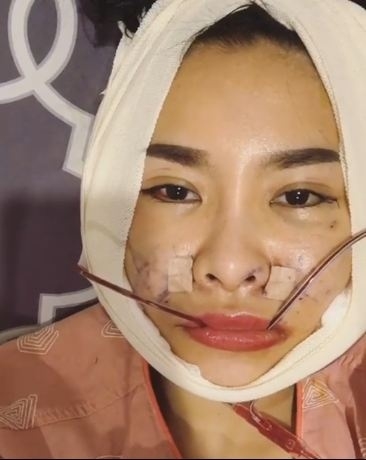 sao việt, mỹ nhân việt, sao phẫu thuật thẩm mỹ, ảnh dao kéo của sao, mỹ nhân việt phẫu thuật thẩm mỹ, phi thanh vân 
